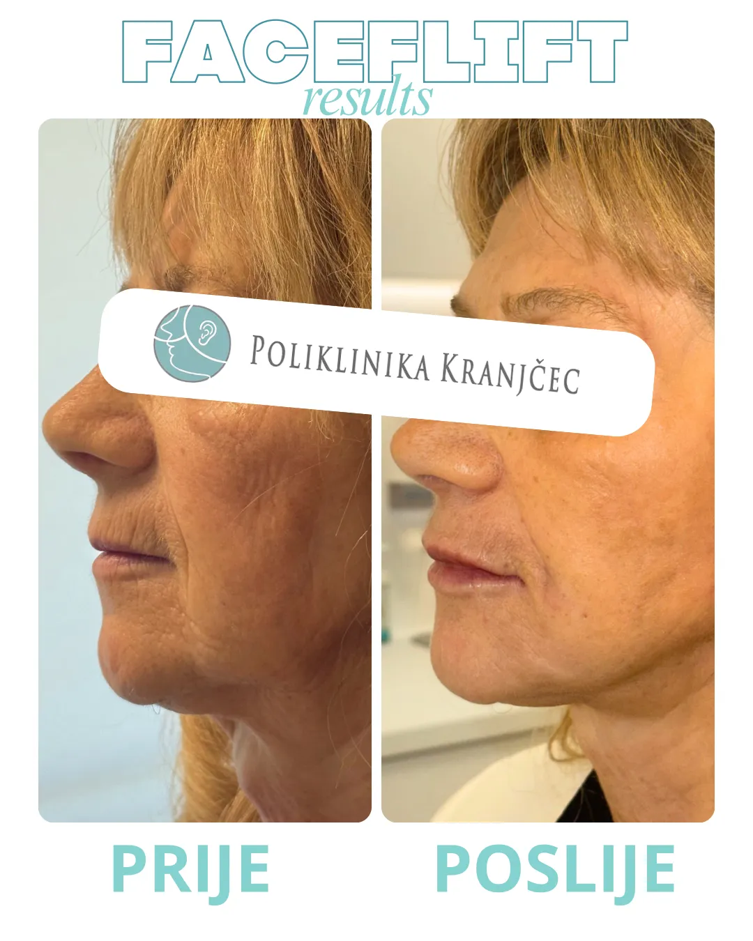 Facelift — slučaj 1, prije i poslije