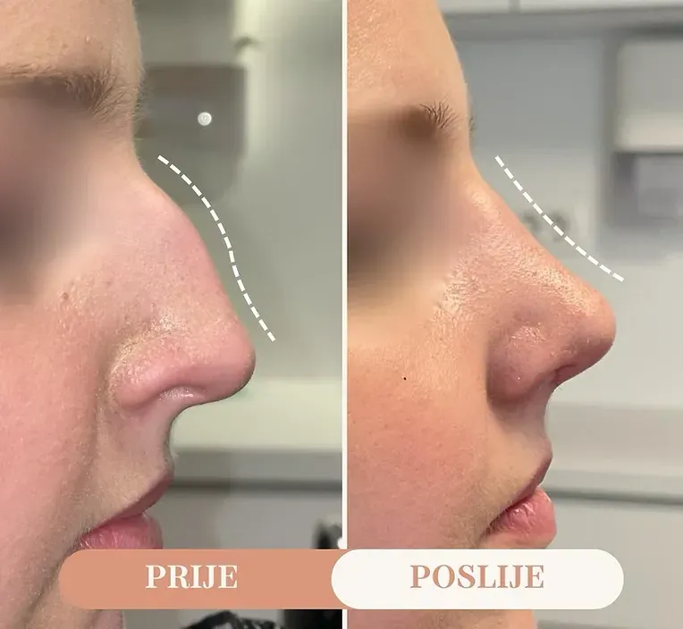 Rinoplastika — slučaj 1, prije i poslije