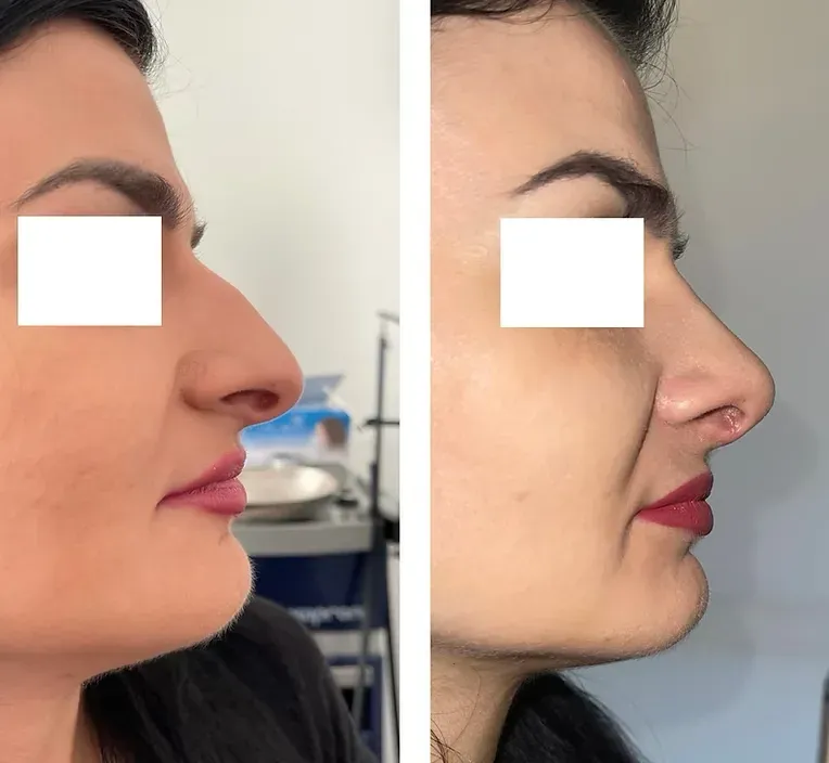 Rinoplastika — slučaj 12, prije i poslije