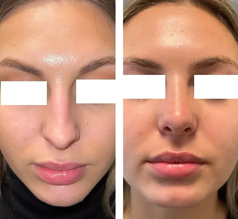 Rinoplastika — slučaj 13, prije i poslije