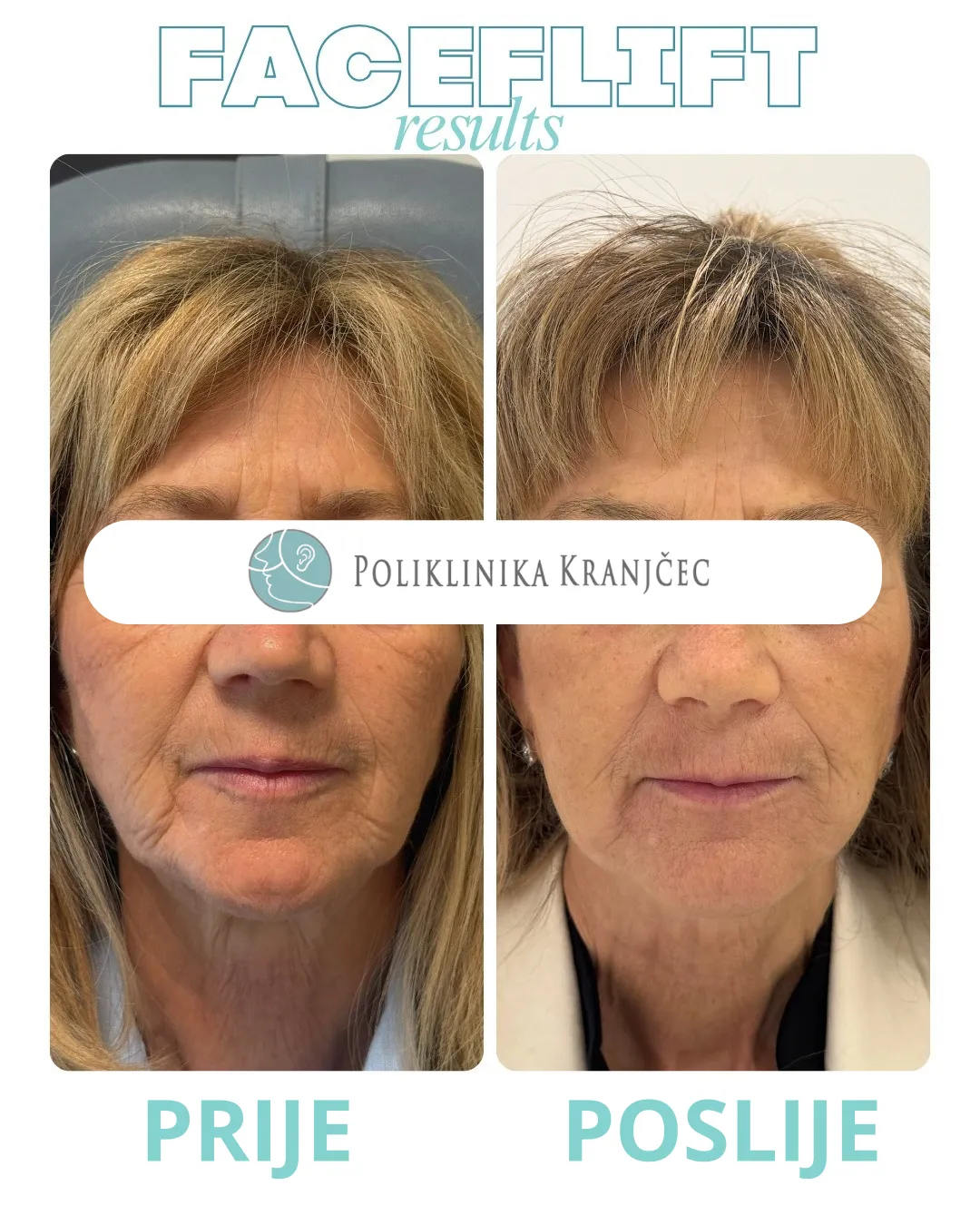 Facelift — slučaj 2, prije i poslije
