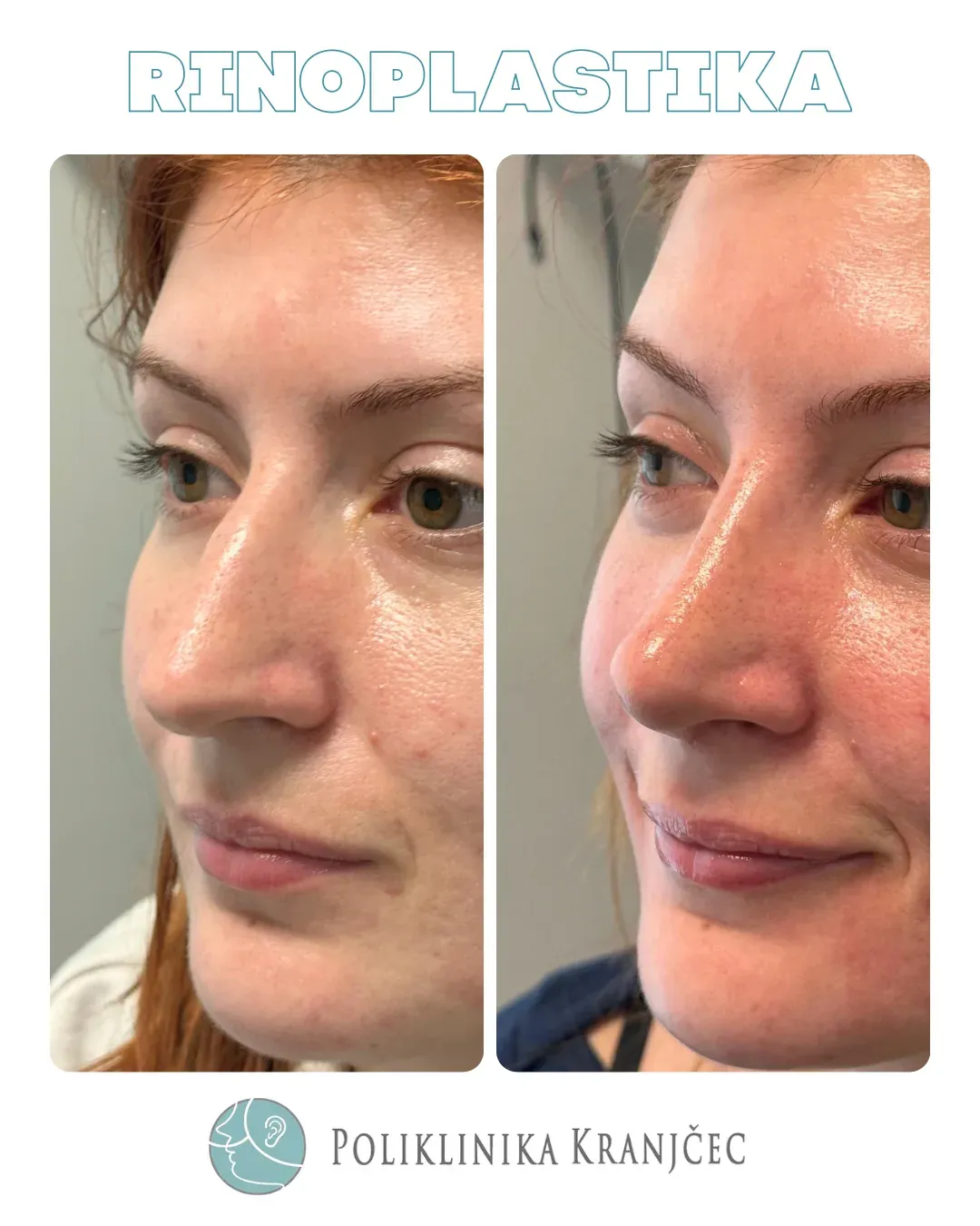 Rinoplastika — slučaj 3, prije i poslije
