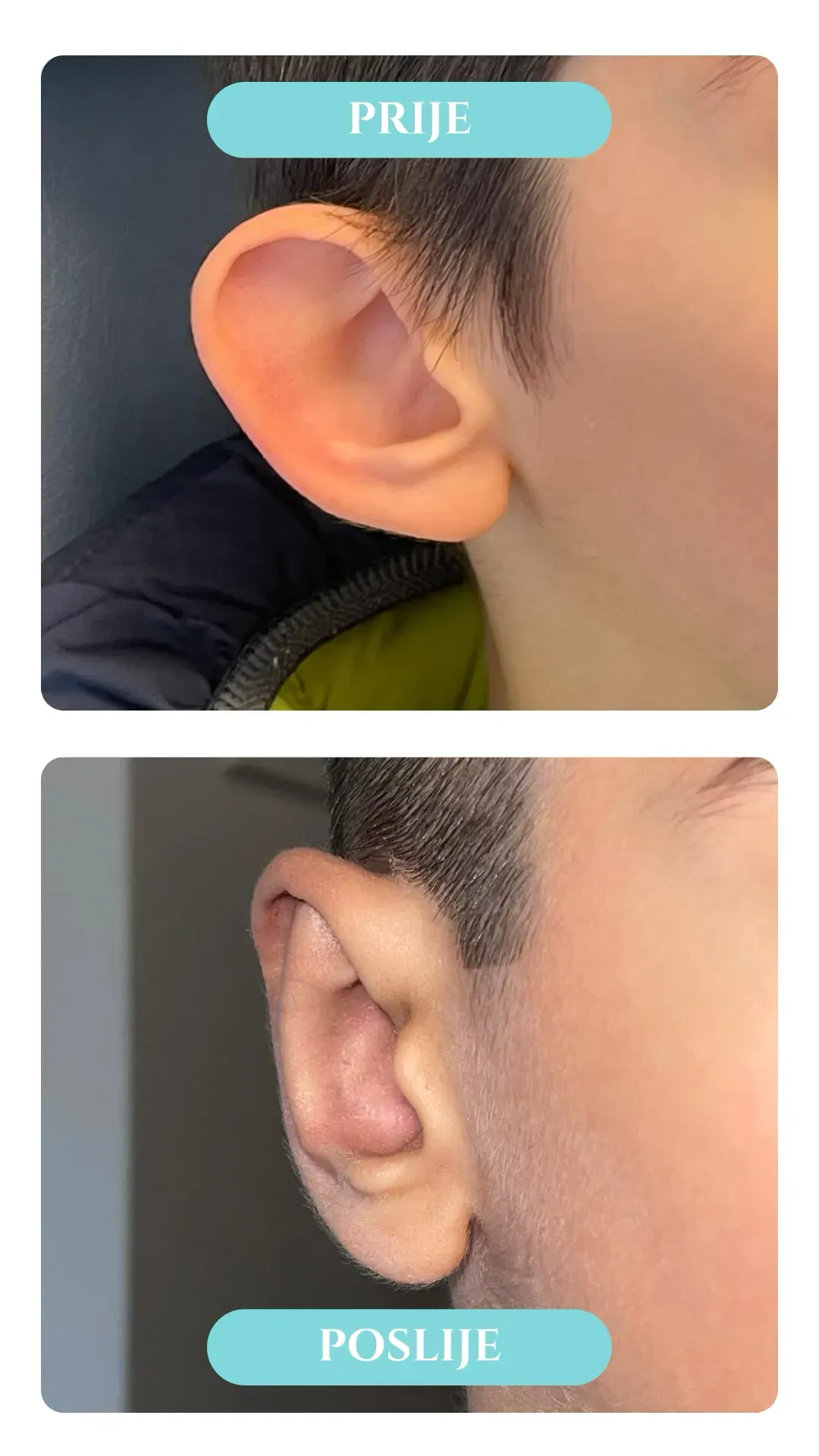 Otoplastika — slučaj 3, prije i poslije