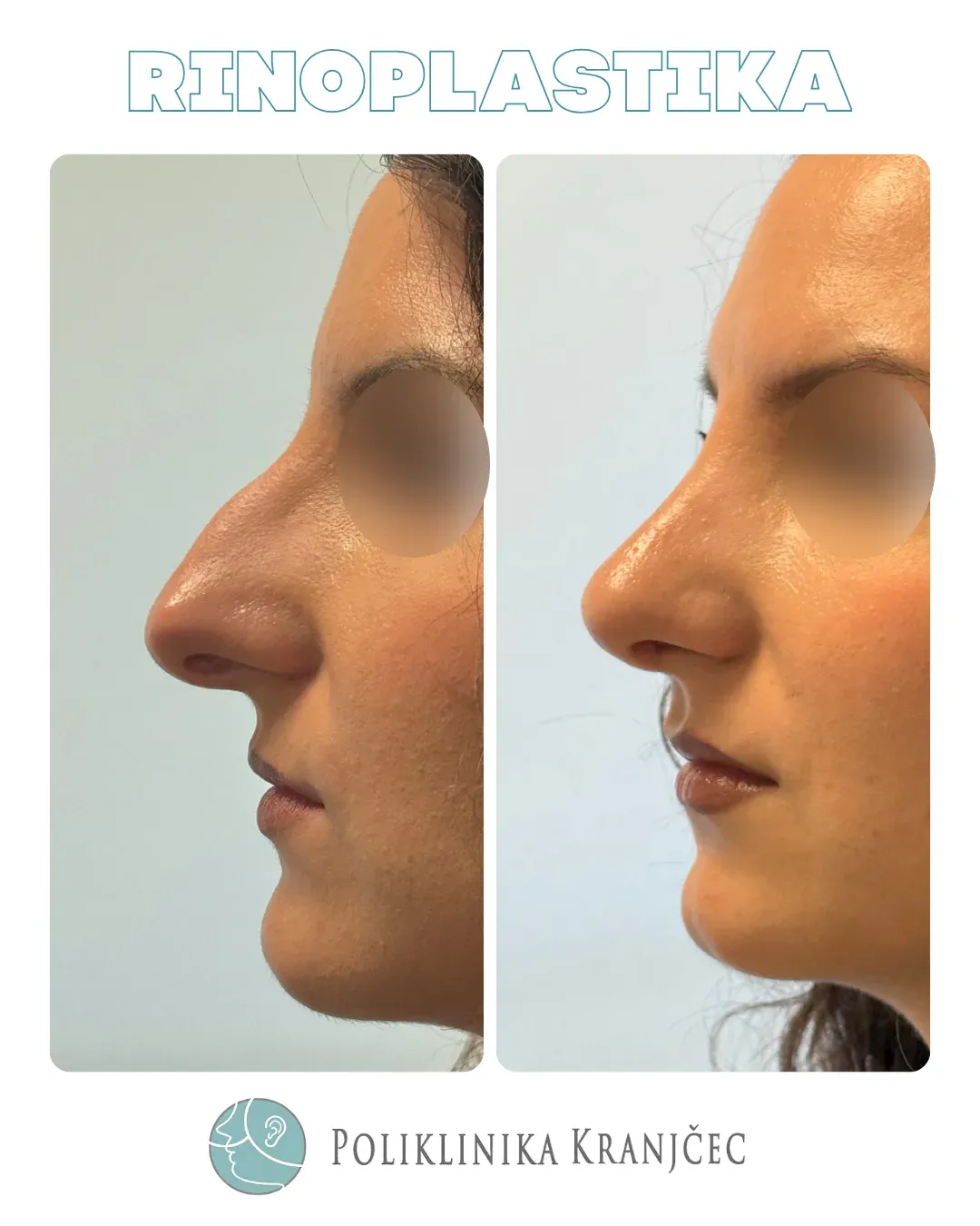 Rinoplastika — slučaj 6, prije i poslije