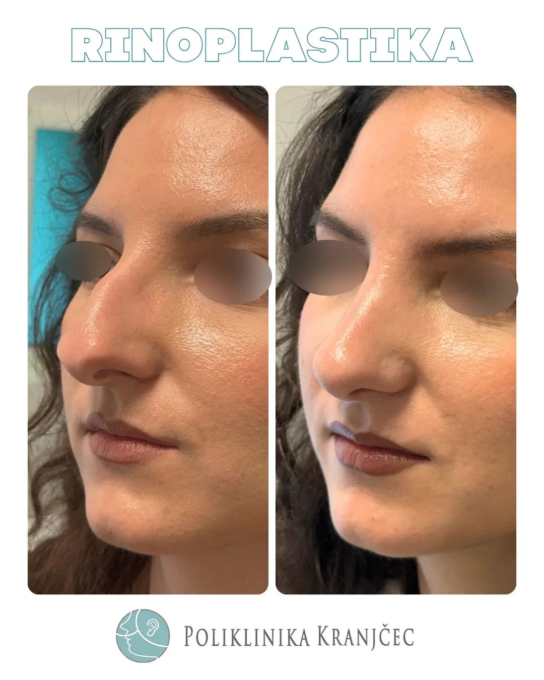 Rinoplastika — slučaj 7, prije i poslije