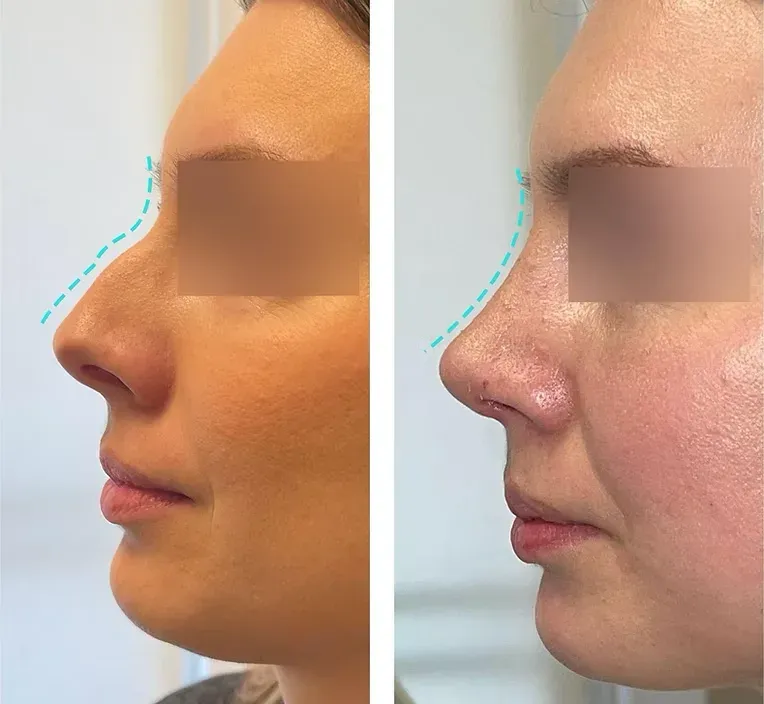 Rinoplastika — slučaj 8, prije i poslije