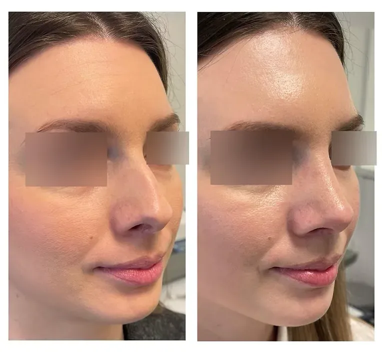 Rinoplastika — slučaj 9, prije i poslije