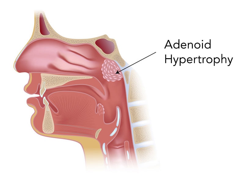 Adenoidektomija