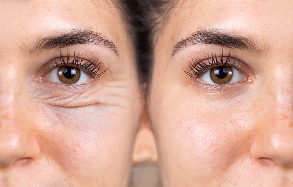 Blefaroplastika i područje oko očiju