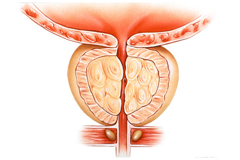 Benigna hiperplazija prostate (BHP): sve što trebate znati