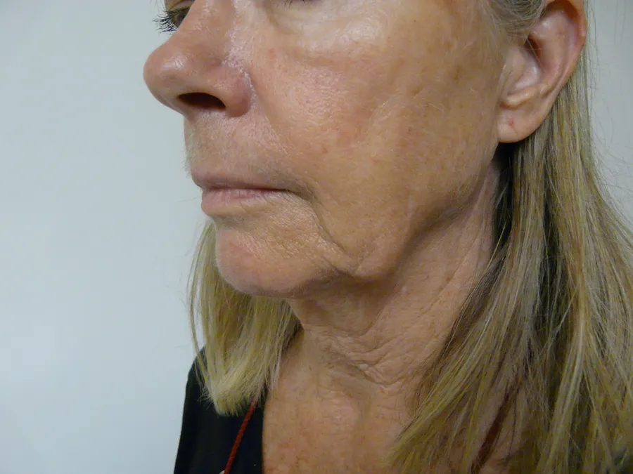 Opuštanje konture čeljusti (jowls) — indikacija za facelift
