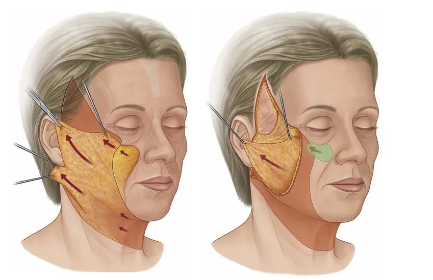 SMAS i deep plane facelift tehnika — ilustracija podizanja dubljih slojeva lica