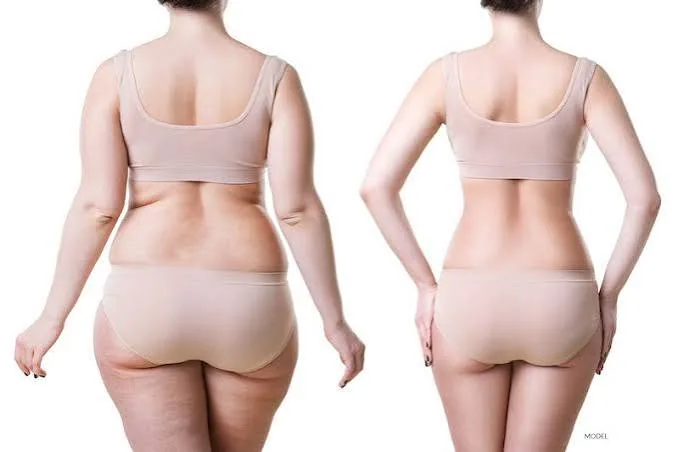 Liposukcija tijela i oblikovanje kontura