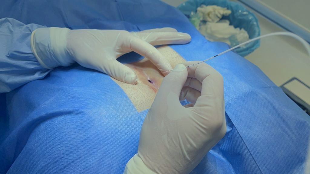 Pilonidalni sinus više nije dugotrajni problem