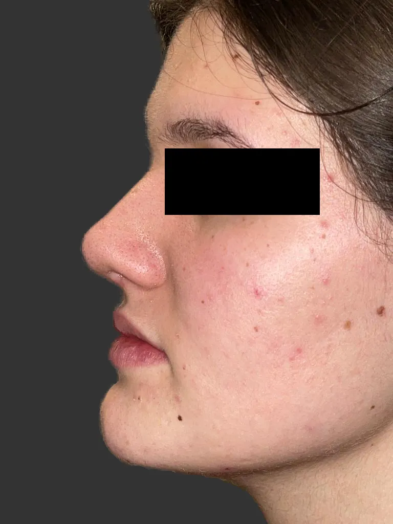 Poslije rinoplastike — profil pacijentice s ravnim hrptom i podignutim vrhom nosa