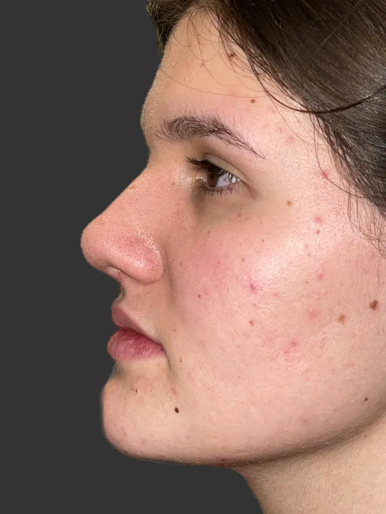 Poslije rinoplastike — profil pacijenta, slučaj 2